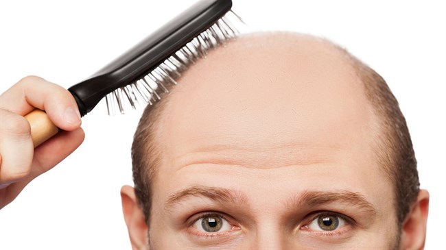 ریزش مو hair loss3 - ریزش مو
