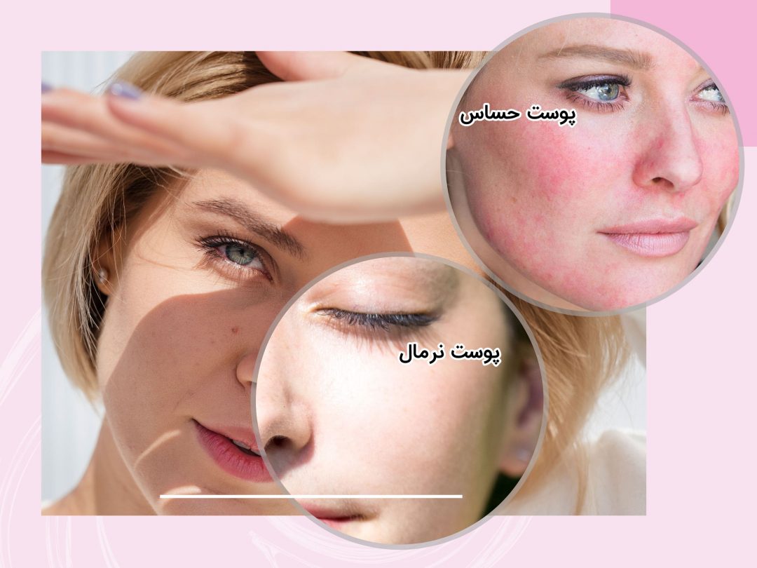 آیا-پوست-شما-در-معرض-سرما-و-گرما-قرمز-می-شود؟-min Question Image