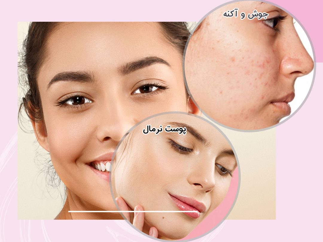 روی-پوست-صورت-آکنه-یا-جای-جوش-دارید؟-min Question Image