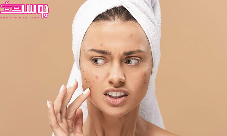 درمان فوری جوش صورت