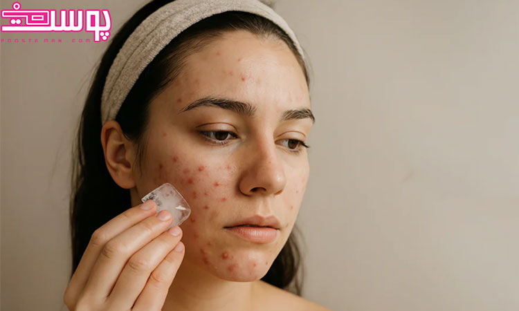 درمان سریع جوش مجلسی با یخ