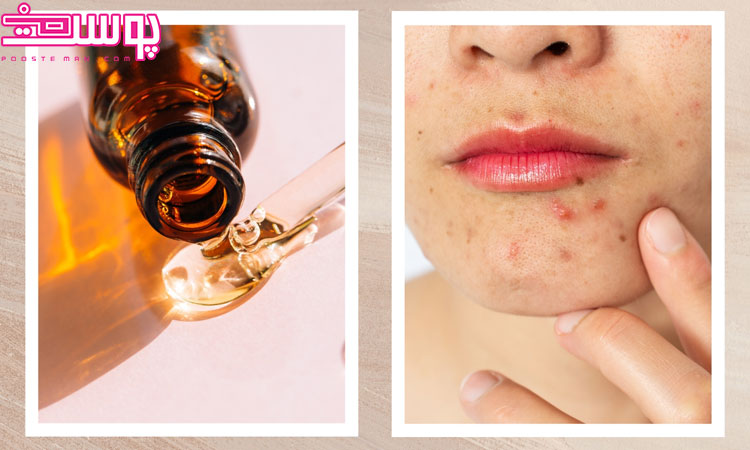 سرم ویتامین سی برای درمان سریع جوش