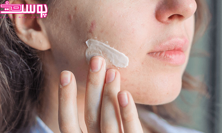 درمان جوش صورت فوری با خمیر دندان