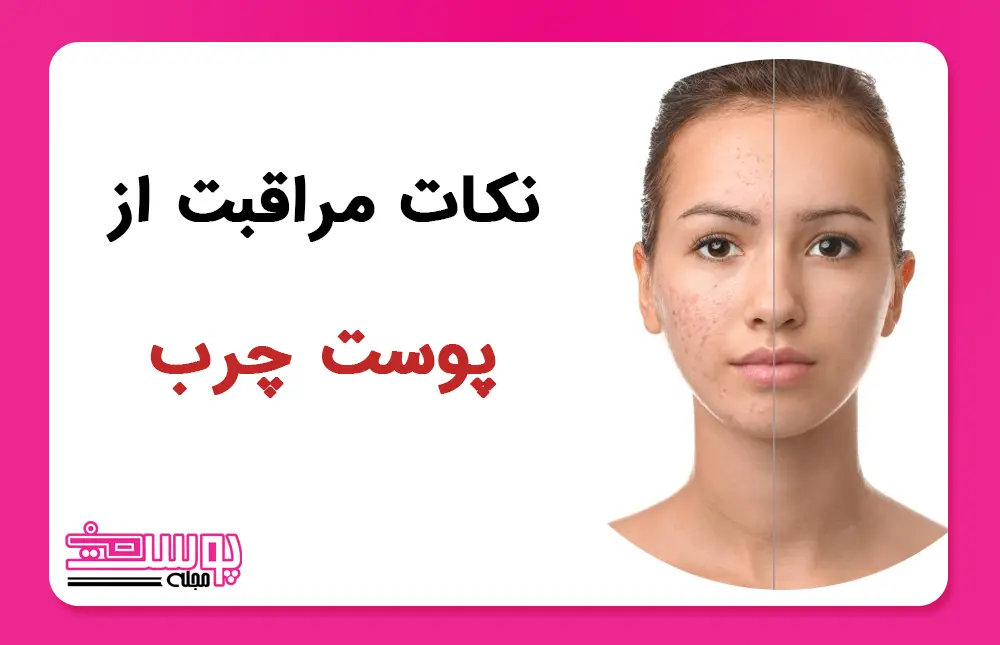 نکات مراقبت از پوست چرب.