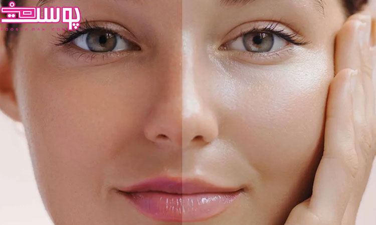 چگونه پوست خود را سفید کنیم؟