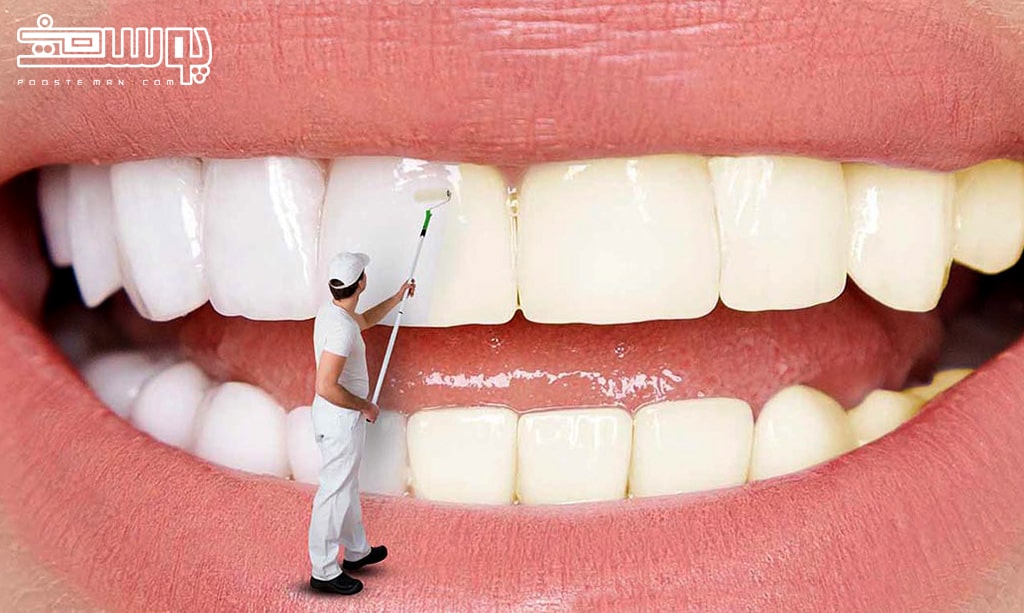 روش های سفید کردن دندان -