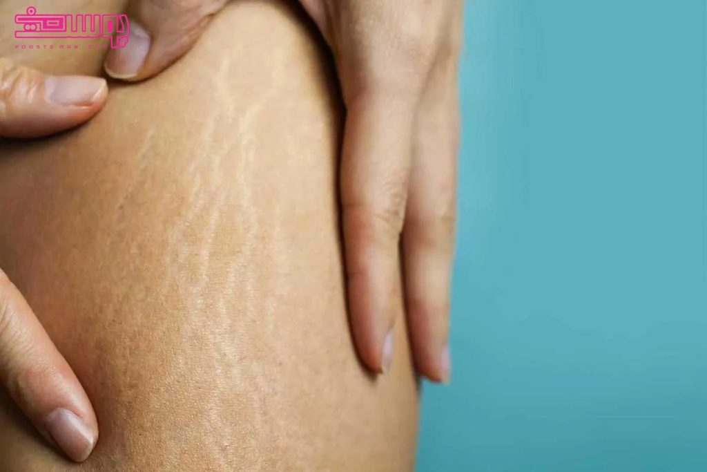روش های درمان ترک پوستی چیست؟