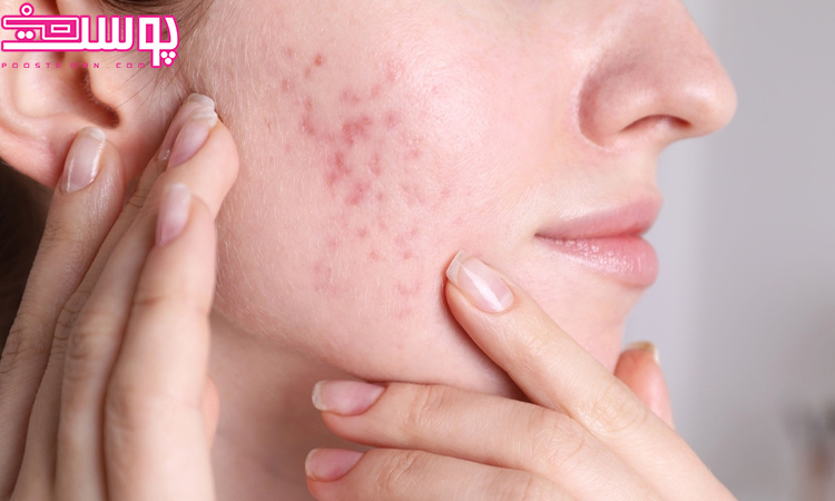 ضد جوش اورژانسی و قوی