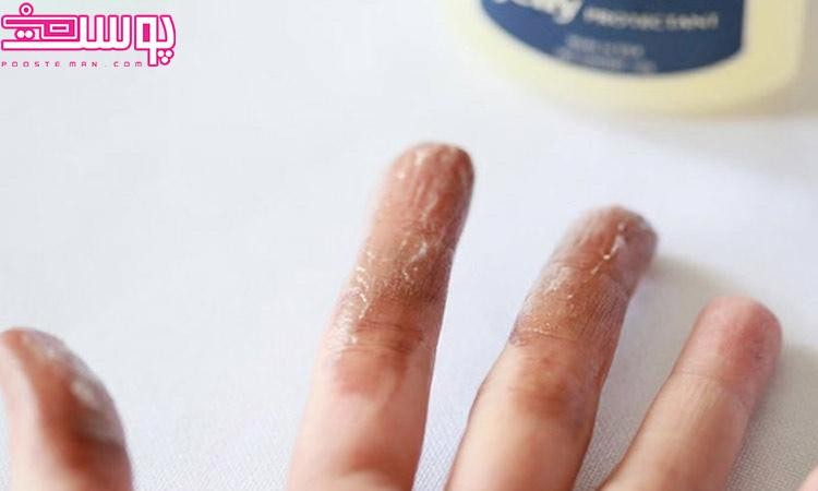 وازلین برای پاک کردن رنگ مو از روی پوست